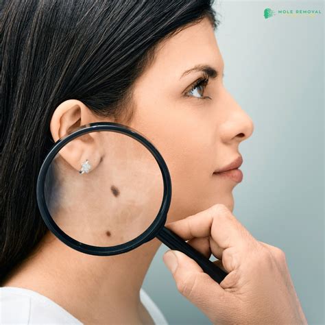 Mole Removal Orange County (@moleremovalOC) / Posts / X
