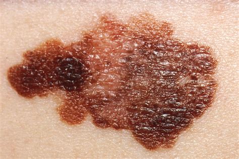 Melanoma | Description, Causes, Symptoms, & Treatment | Britannica