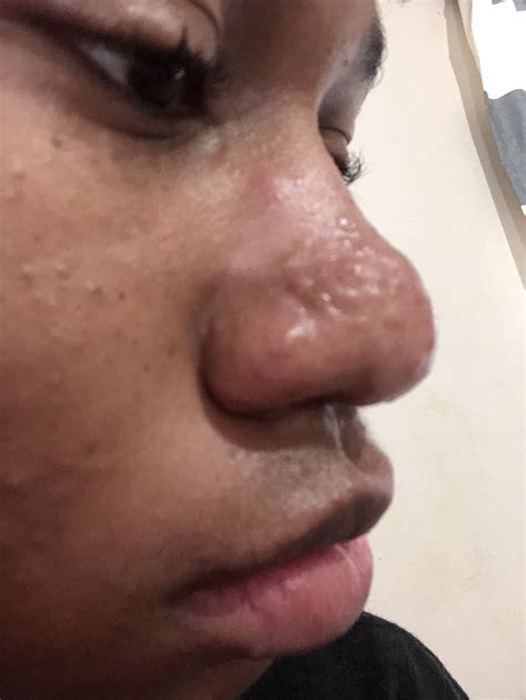 Raised Hypertrophic Nose Acne Scars. Help me plzzz – Hypertrophic (raised) scars – Acne.org Forum