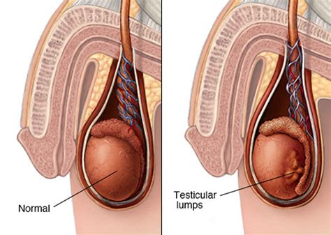 Lump On Testis Pictures