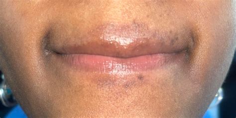 Random Dark Spots Around Mouth : r/DiagnoseMe