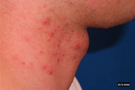 Ingrown Hair Armpit Abscess Swollen Firm Nodule That Felt