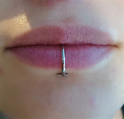 Vertical Labret Scar