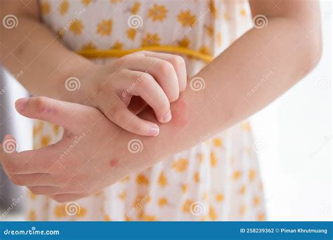 Rash between fingers itchy. Itchy Fingers: Causes, Symptoms, and Effective Treatments