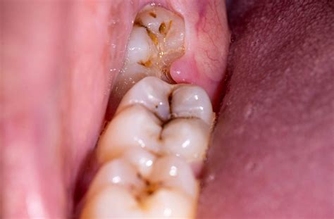 What Does a Cavity Look Like? | Toronto