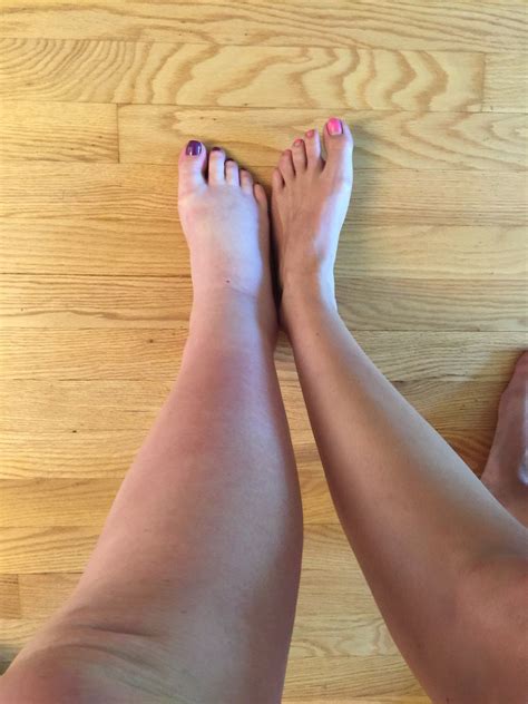 Feet Swelling Up After Giving Birth at Preston Lamb blog