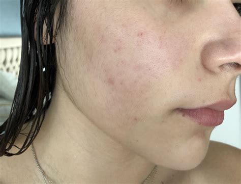Red Marks Left After Acne: Red Spots After Acne – BTMPSP
