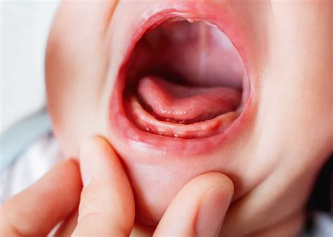 Tongue Tie treatment | An Osteopathic Approach | Balwyn North