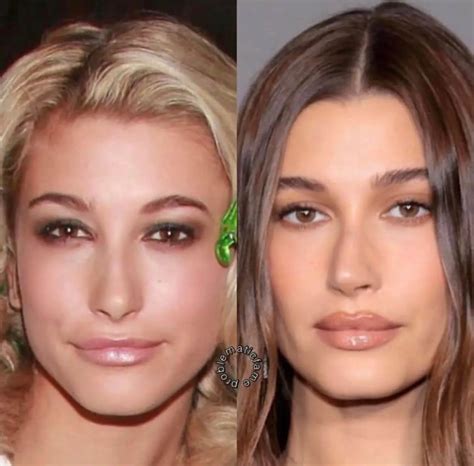 Hailey Bieber's Nose Job: Is She Another Celebrity Undergone Cosmetic ...