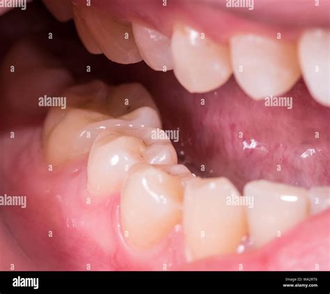 Healthy human molar teeth close up view Stock Photo - Alamy