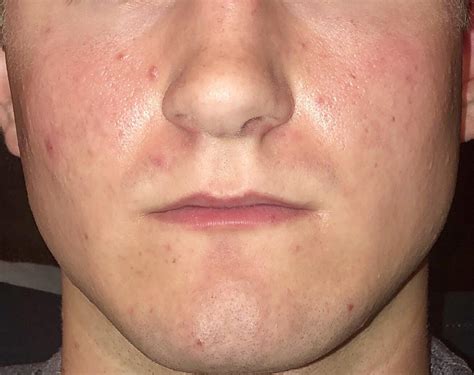 How to treat closed comedones. What is the best treatment for this? I’ve used salicylic acid ...