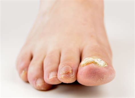 Why Are My Toenails Thick And Brittle at Christiana Shepherd blog