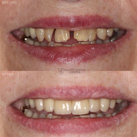 Smile Gallery - Pacific Dental Center
