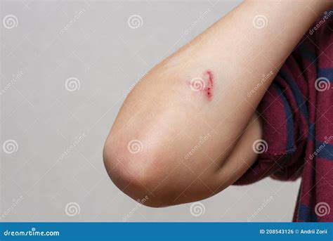 Deep Scratches on the Skin with Bruises on the Childs Hand. Wounds Scratches Abrasions on the ...