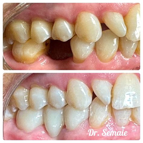 Dr. Ermias Semaie, DDS on LinkedIn: 3 unit dental bridge