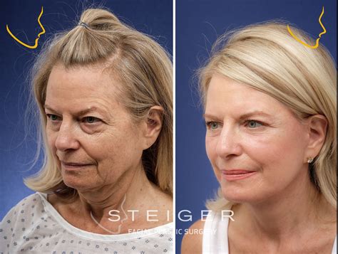 Deep plane facelift procedure cost recovery – Artofit
