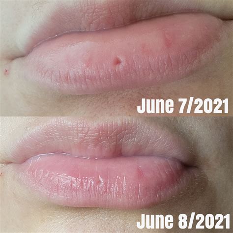 Vertical Labret Scar By Unusual Lip Piercings