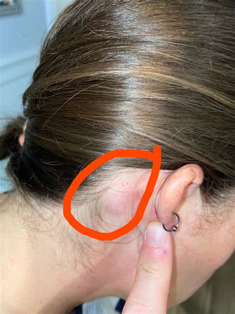 Cancer Lump Behind Ear Understanding Lymph Nodes Behind The Ear: