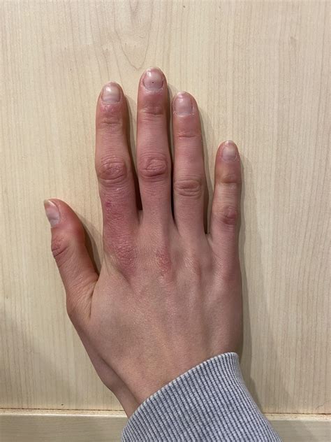 Anyone else have constantly red/purple, swollen hands? : r/Raynauds