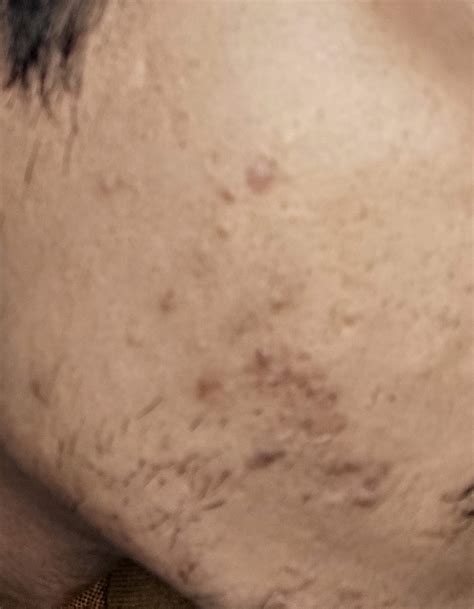 Ask a Dermatologist Online for Facial Acne Scars / Cysts