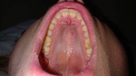 Tiny Bumps On Mouth Roof - A Small Percentage Of People Have A Bump On ...