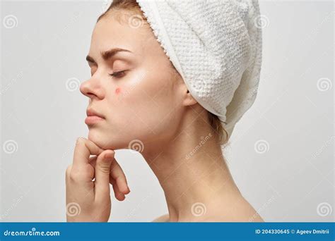 Attractive Woman with Towel on Head Naked Shoulders Pimples on Face ...