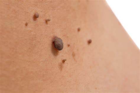 Skin Tag Removal - Clinic M