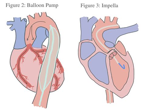 Mechanical Support: Impella and Balloon Pump — When the Beat Drops: A ...
