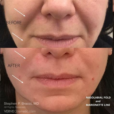 Non surgical treatment for nasolabial folds and marionette lines – Artofit