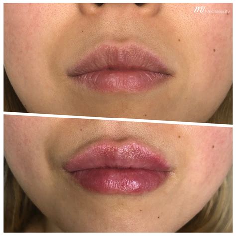 List 100+ Pictures Before And After Lip Flip Photos Superb