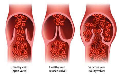 Venous Insufficiency: 10 Powerful Benefits Of A Venous Ultrasound For Leg Health