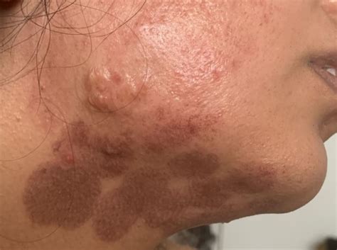 Laser horror story: Woman left with face burns after hair removal ...