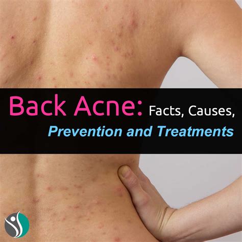 Back Acne: Facts, Causes, Prevention, and Treatments | Consumer Health Weekly