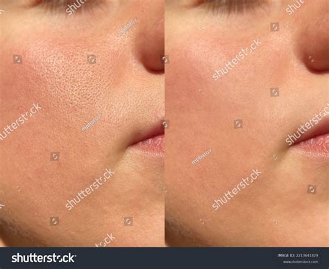 Large Pores Before And After