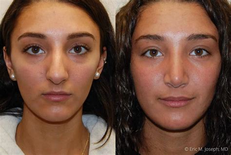Septoplasty And Turbinate Reduction Before And After