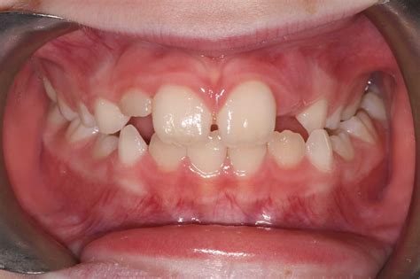 Removable Palate Expanders To Widen Upper Jaw | Mellion Orthodontics