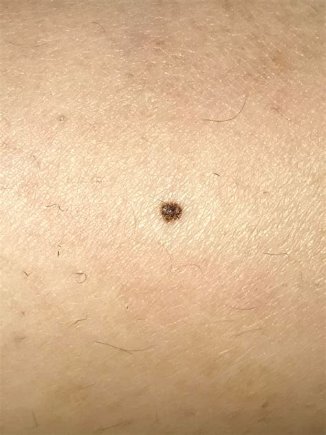 Found these black dots on my scrotum / penis. Does this look concerning? : r/Melanoma
