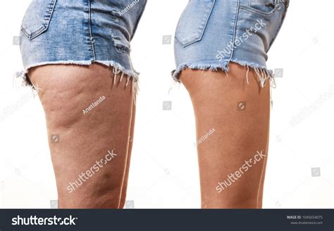 Cellulite On Legs