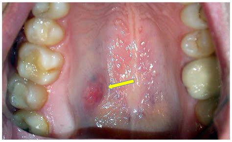 Epidermoid Carcinoma Mouth