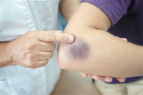 How to Treat a Bruise | Oxford Urgent Care