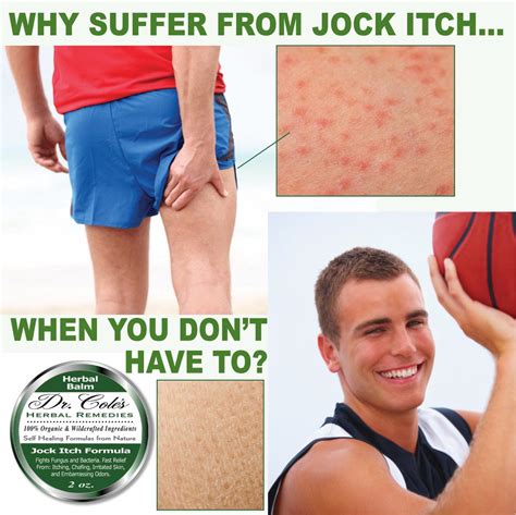 Jock Itch In The Anus at Douglas Jacobson blog