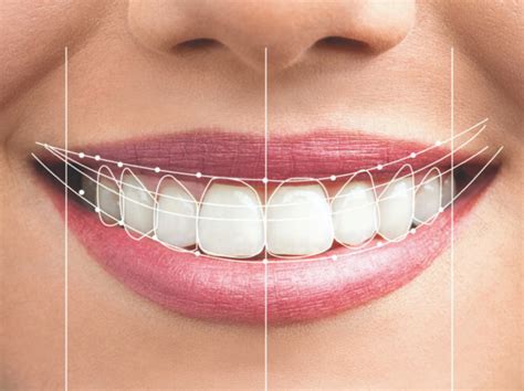 The Art of Smile Design: Your Path to a Perfect Smile