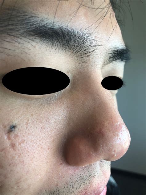 What Is Cigarette Paper Atrophic Scarring