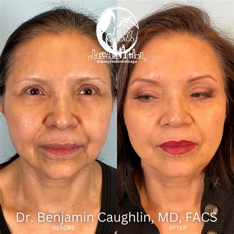 PERIORAL MOUND TREATMENT BEFORE & AFTER GALLERY