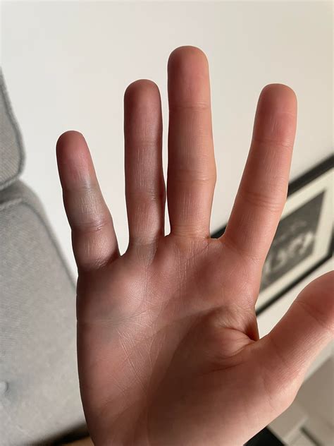Bruised finger / ligament? : r/InjuriesAndWounds