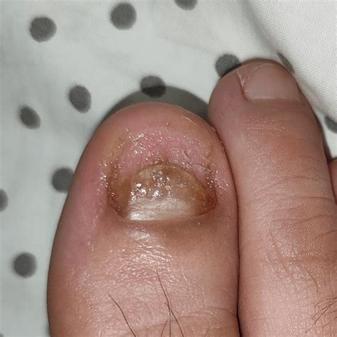 Hard and thick toenail 6 months after being removed. Why does it look like this? How do I make ...