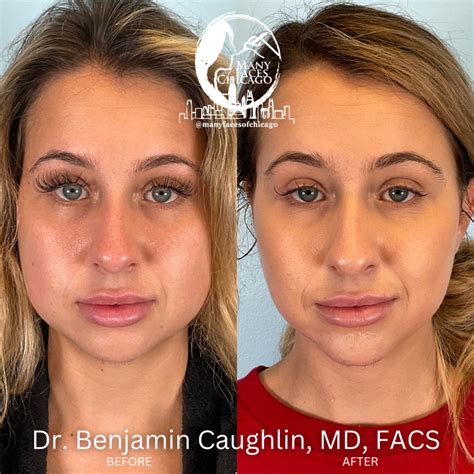 Top Benefits of Buccal Fat Removal Combo Treatment Procedures to Maximizing Beauty