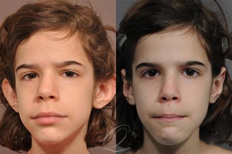 Otoplasty (Ear Pinning) Before & After Photos Patient 1001586 | Serving Rochester, Syracuse ...