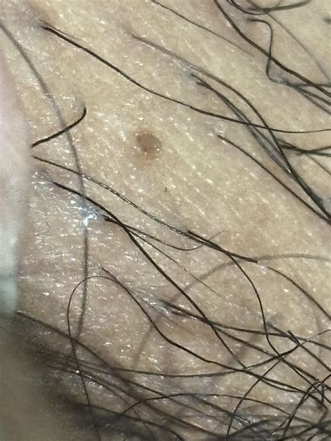 Skin tag or genital warts? : r/DermatologyQuestions