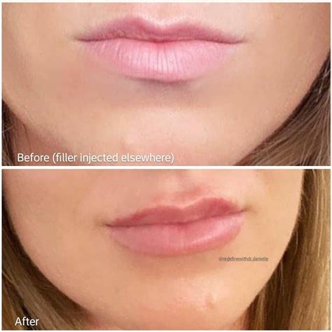 46 Likes, 6 Comments - Dr. Danielle Sergeeva (@redefinewithdr.danielle) on Instagram: “I ...